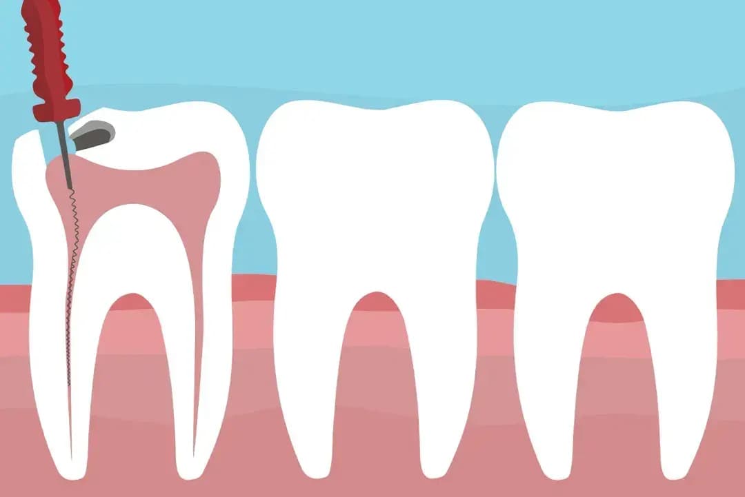 علاج عصب الأسنان اللبنية