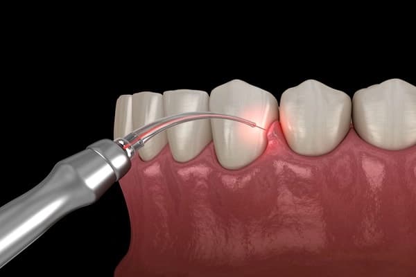 علاج التهابات اللثة